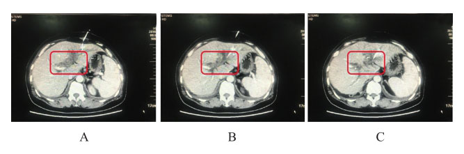 图2 左右肝管汇合区占位.jpg